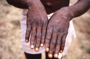 Monkeypox1